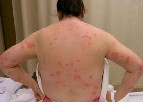 Чем вызвана аллергия на клопов и возможно ли ее вылечить?