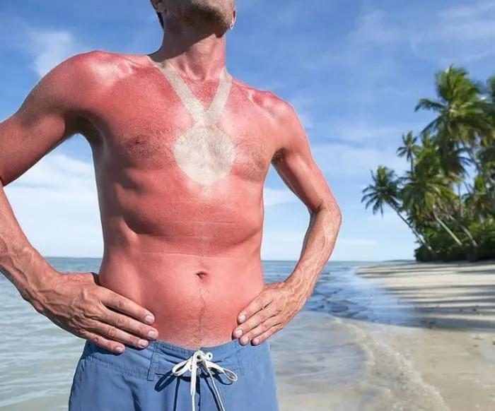 Смешные примеры неудачного загара (16 фото) Смешные примеры неудачного загара (16 фото)