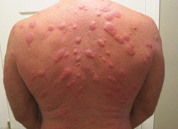 Постельные клопы и средства для самостоятельной борьбы с ними