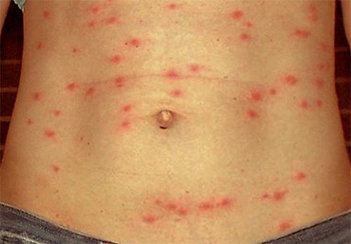 Человеческие головные вши и заболевания, которые они распространяют