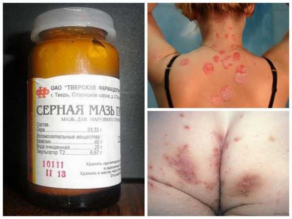 Как бороться с чесоточным клещом и методы лечения