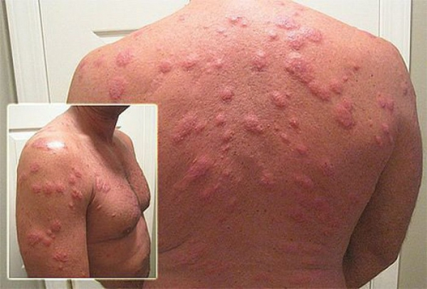 Клещи домашней пыли и методы борьбы: укусы, симптомы и лечение Клещи домашней пыли и методы борьбы: укусы, симптомы и лечение